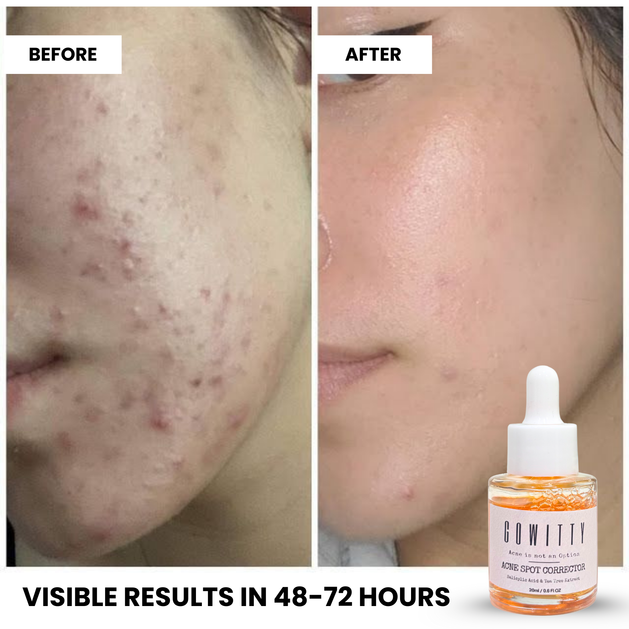 Acne Spot Corrector – 2% Salicylic Acid + Tea Tree Extract | Fast-Acting Acne Treatment for Pimples, Dark Spots & Breakouts | Niacinamide | 20 ml